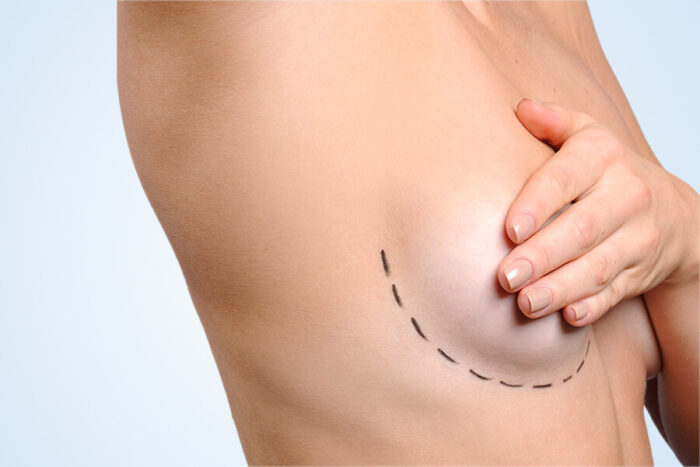 Breast Enlargement in Turkey
